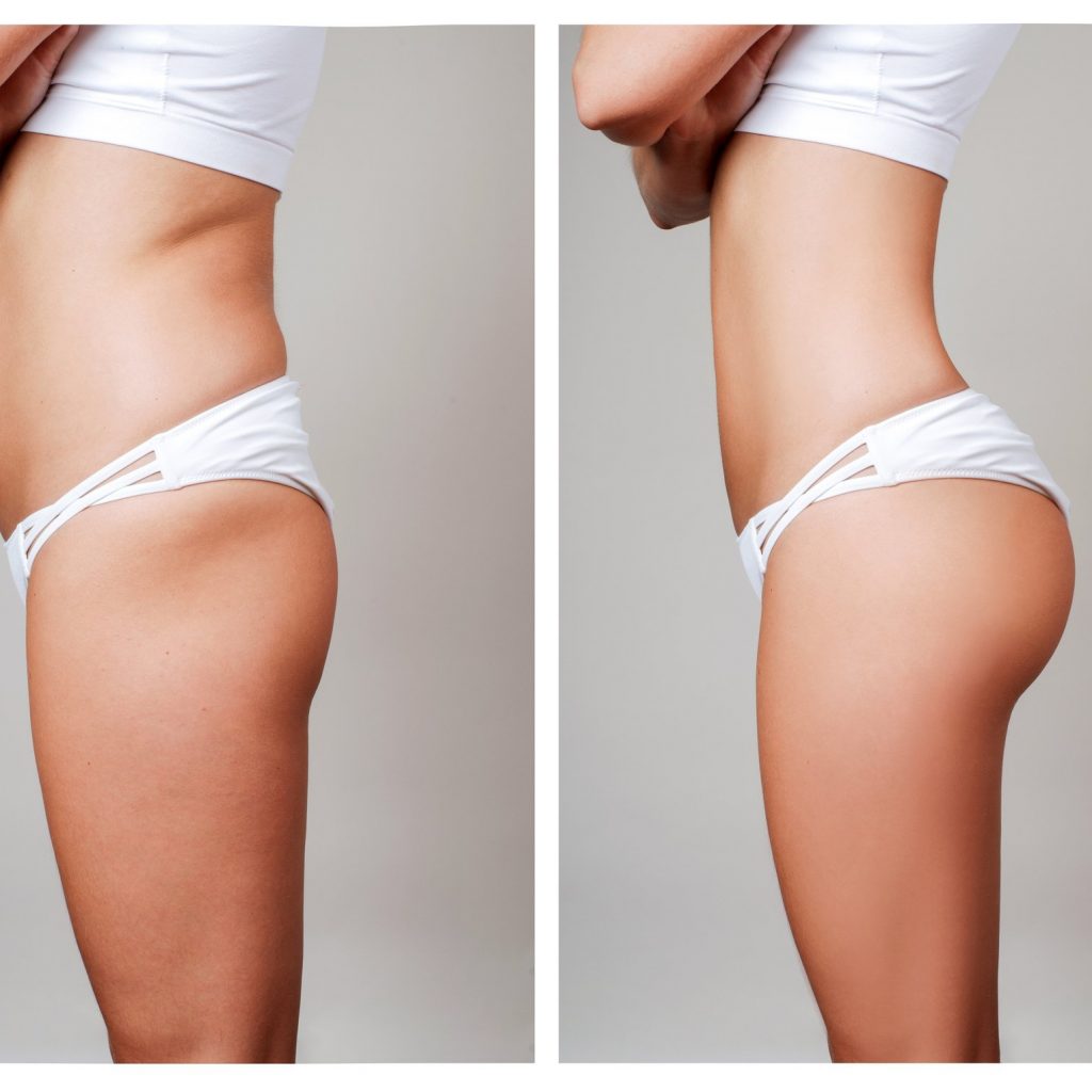 The Pros and Cons of Fat Transfer Breast Augmentation