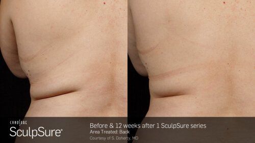 Sculpsure