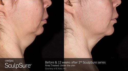 Sculpsure