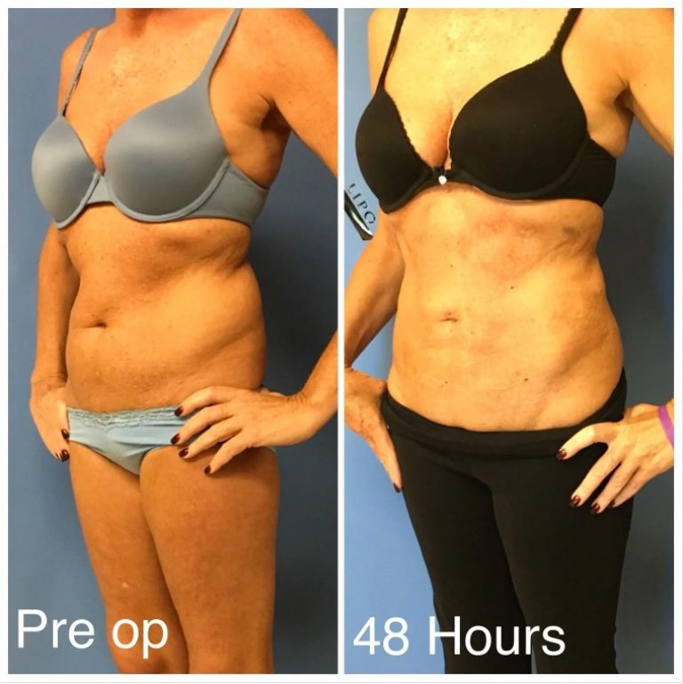 liposuction six pack in women