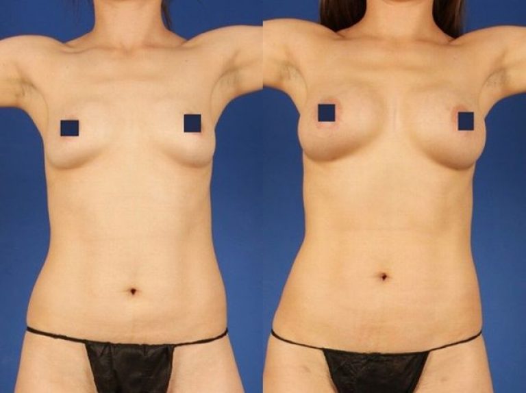 liposuction breast transfer