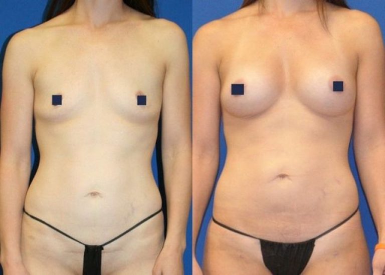 liposuction breast transfer