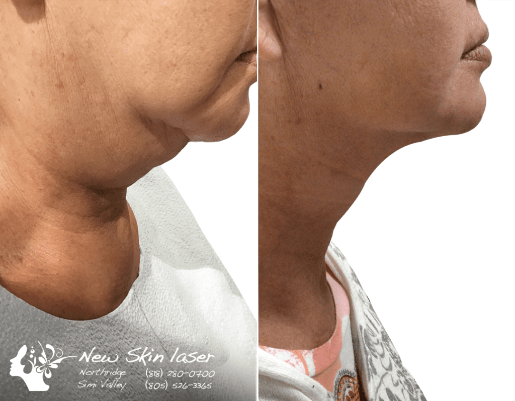 liposuction double chin submental fat removal