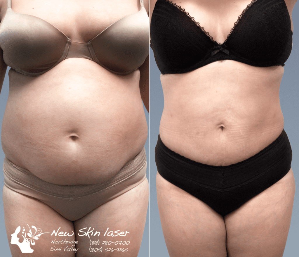 belly abdomen liposuction results before and after new skin laser