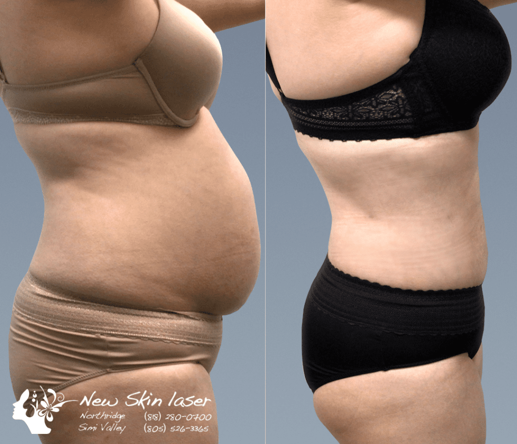 liposuction belly fat removal side view