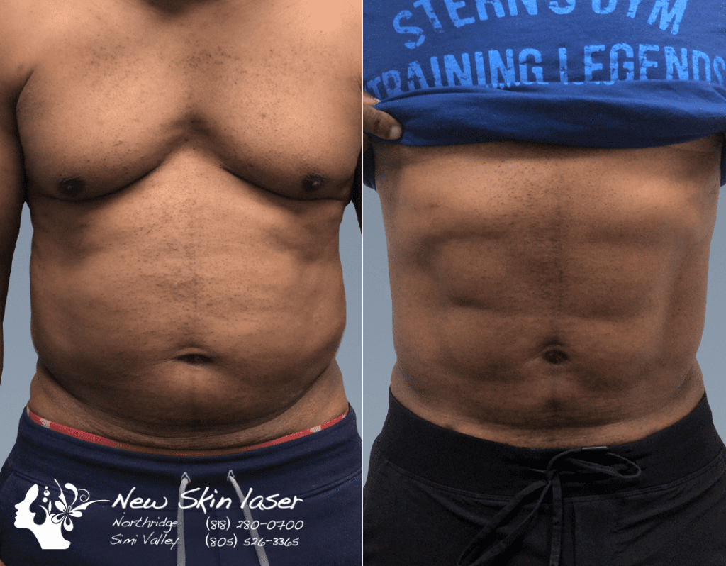 hd liposuction ab sculpting