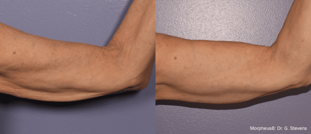 Morpheus8 arm skin tightening before and after