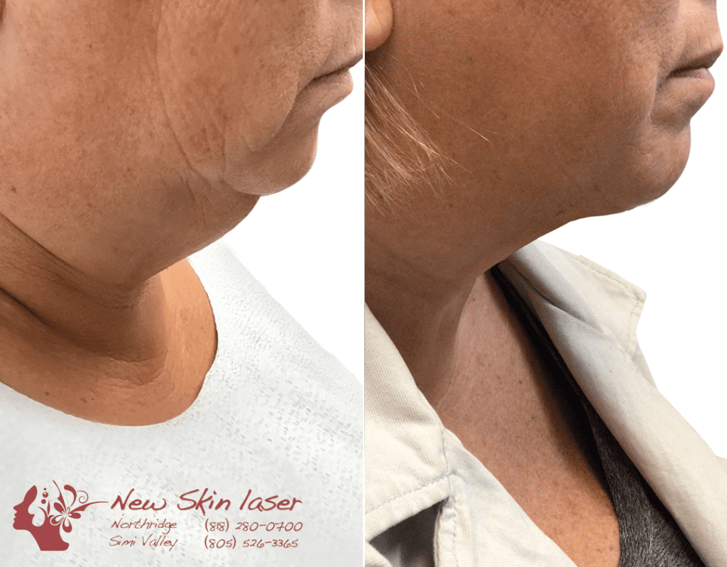 liposuction double chin before and after