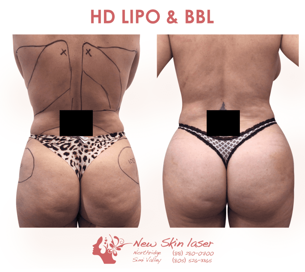 female liposuction belly fat removal with fat transfer brazilian butt lift