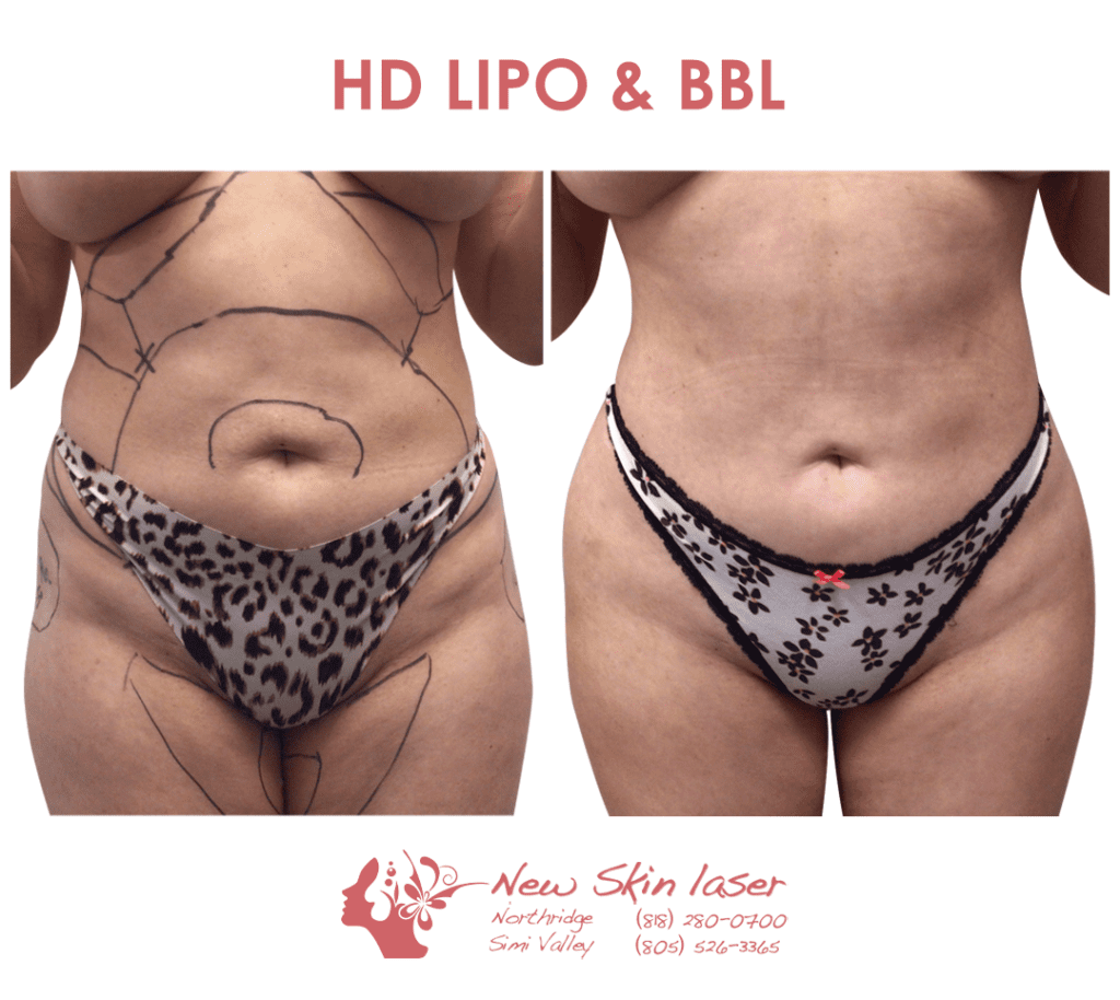 female liposuction belly fat removal with fat transfer brazilian butt lift