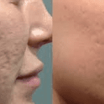 Microneedling