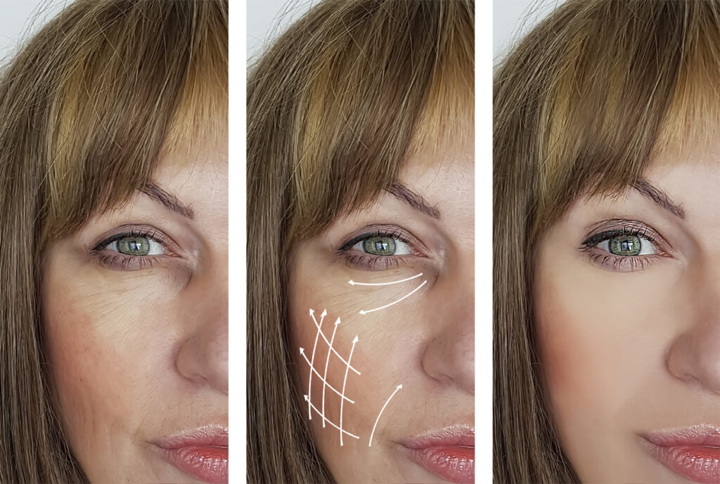 skin-tightening-new-skin-laser-center