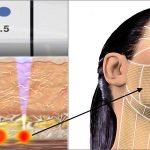 Ultherapy prices and specials in Thousand Oaks