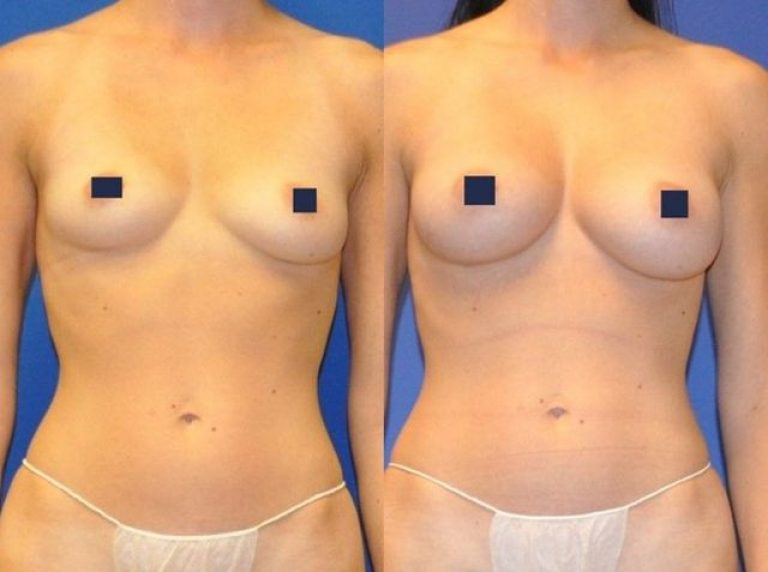 liposuction breast transfer