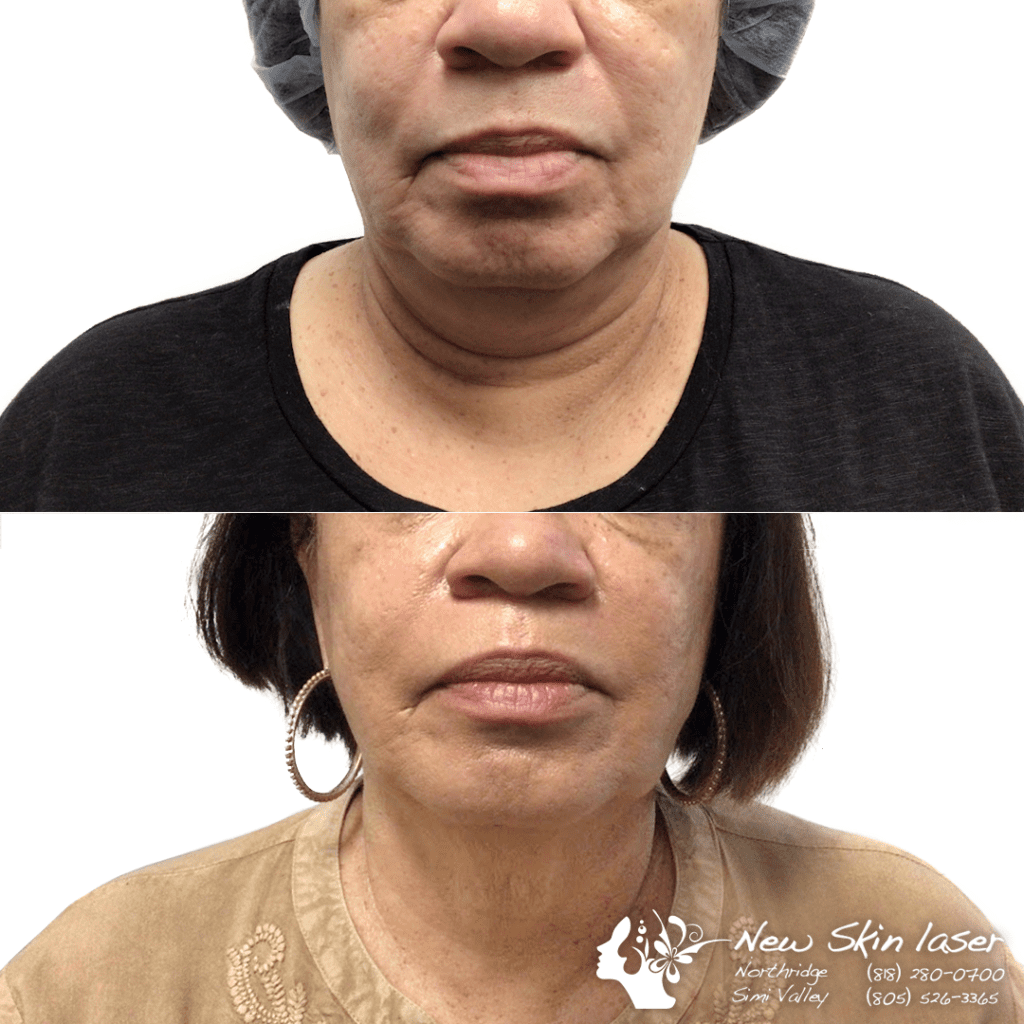 liposuction double chin removal