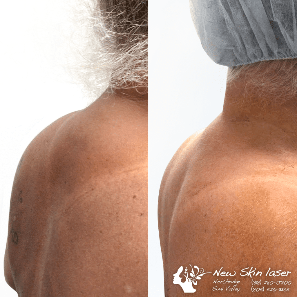 liposuction back of neck hump removal