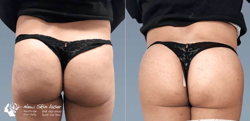 liposuction butt lift