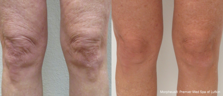 morpheus8 knee skin tightnening before and after