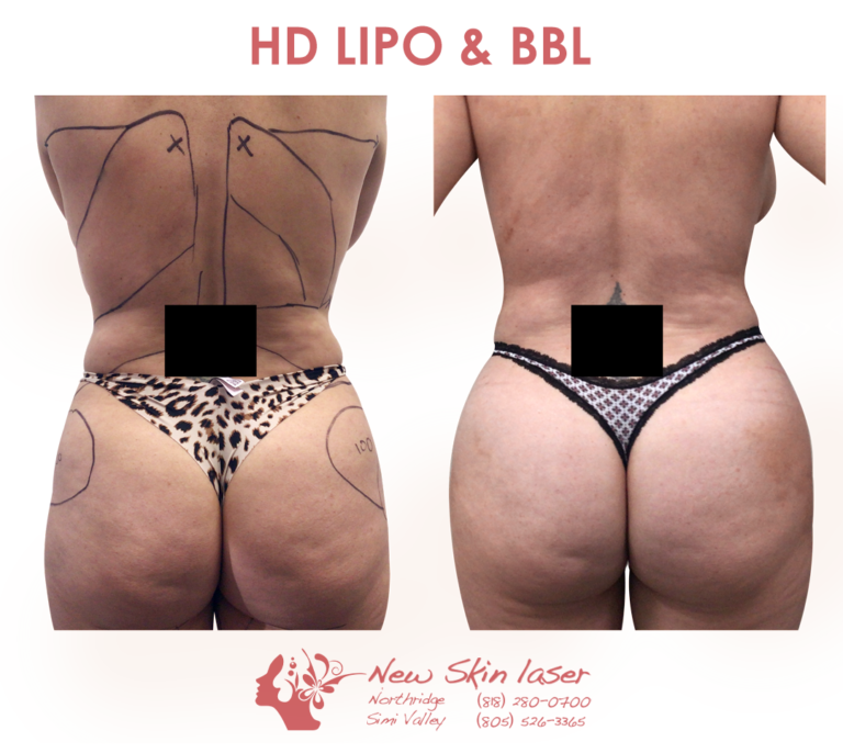 female liposuction belly fat removal with fat transfer brazilian butt lift