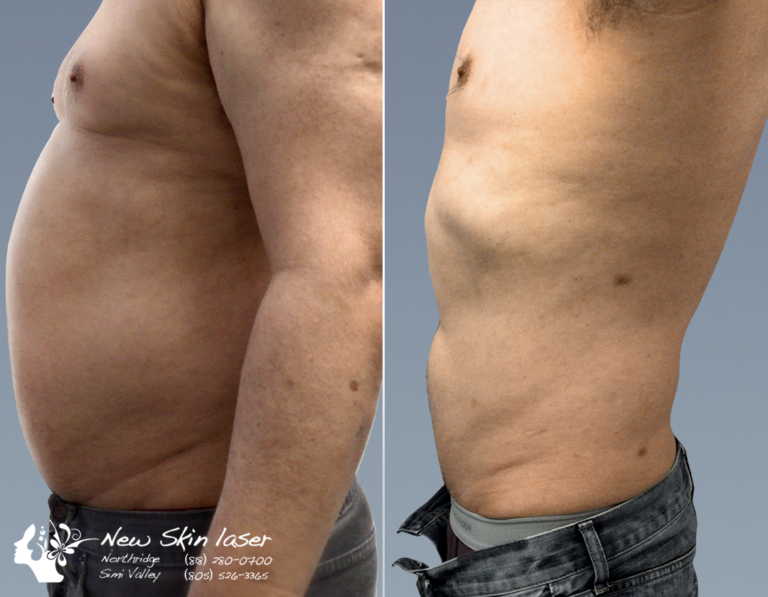 liposuction male abdomen belly fat removal before and after