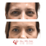 Botox Uses